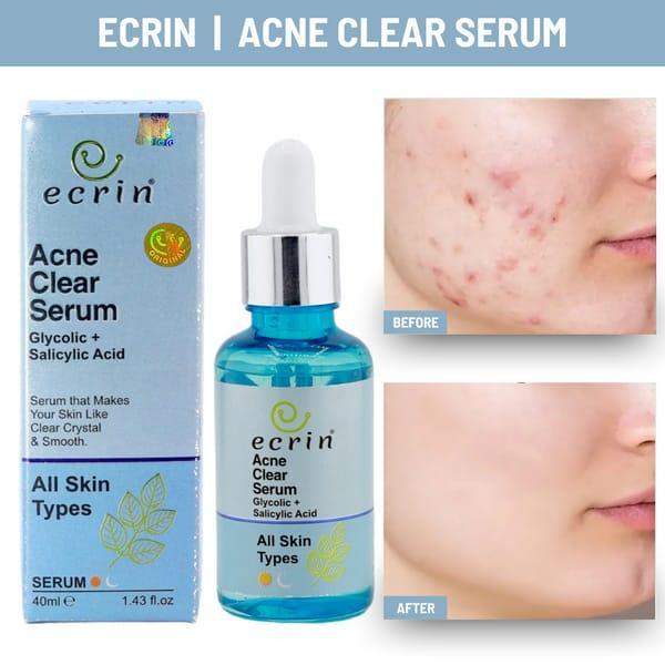 Acne Clear Serum